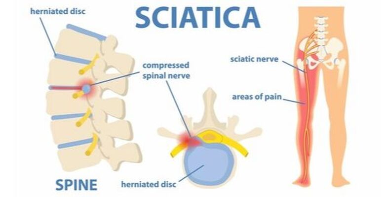 7 Tips for Fast Sciatic Pain Relief